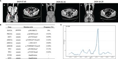 Clinical Benefit With PARP Inhibitor for Pathogenic Germline FANCA-Mutated Relapsed Epithelial Ovarian Cancer: A Case Report